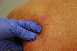 dry needling